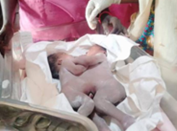 Transférés à Kinshasa pour être séparés, Les bébés siamois évacués du Kwilu n’ont pas survécu