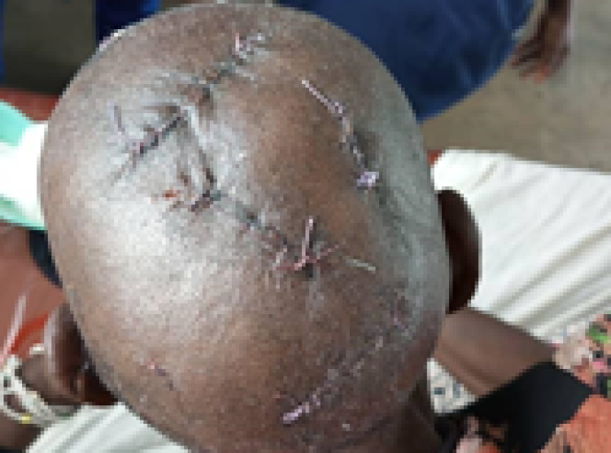 Bulungu : une enseignante victime d’extorsion, des coups et blessures graves et d’une main cassée